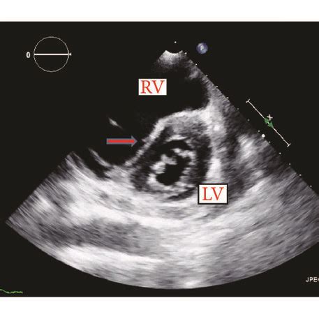 d shaped left ventricular septum.